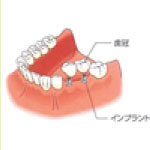 インプラント