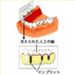 インプラント